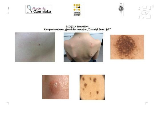 Profilaktyka czerniaka