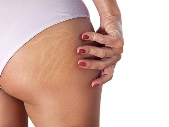 Rozstępy – czy trzeba się z nimi polubić? 