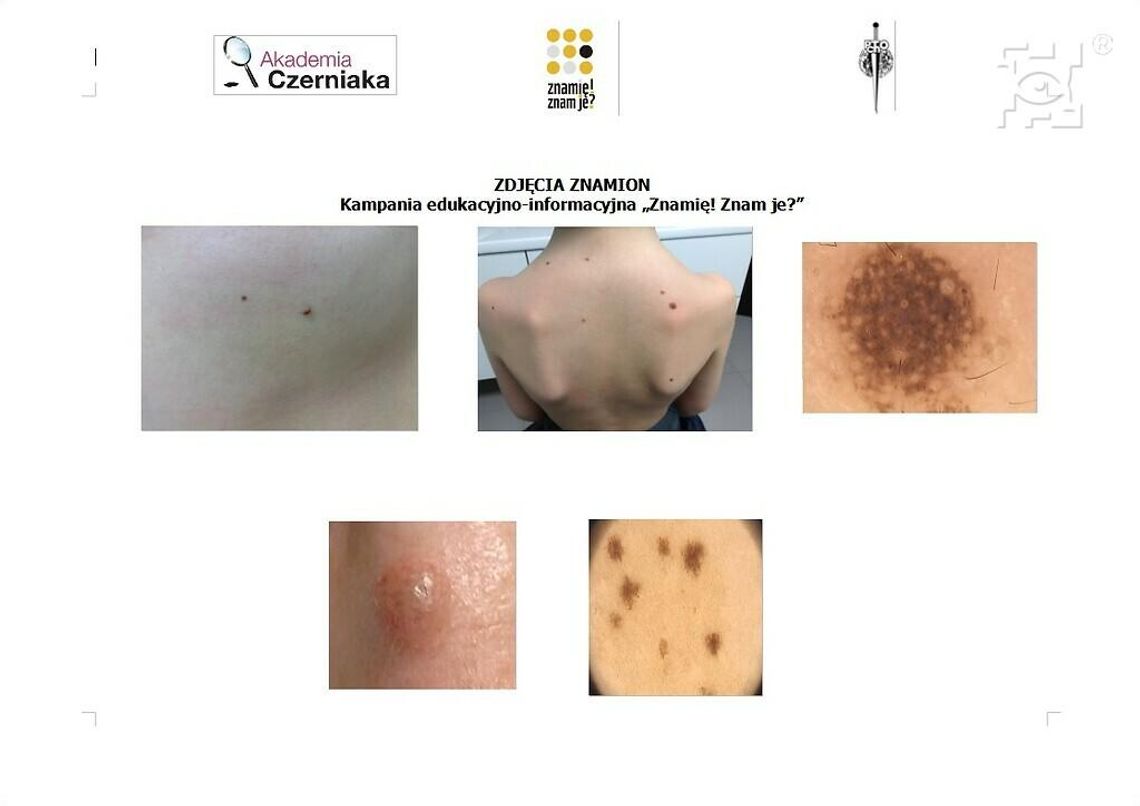 Profilaktyka czerniaka Profilaktyka czerniaka